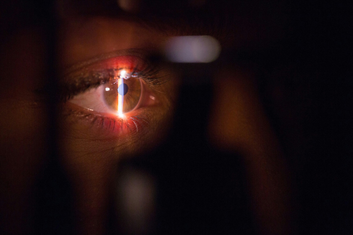 Augen Iris Laser Behandlung